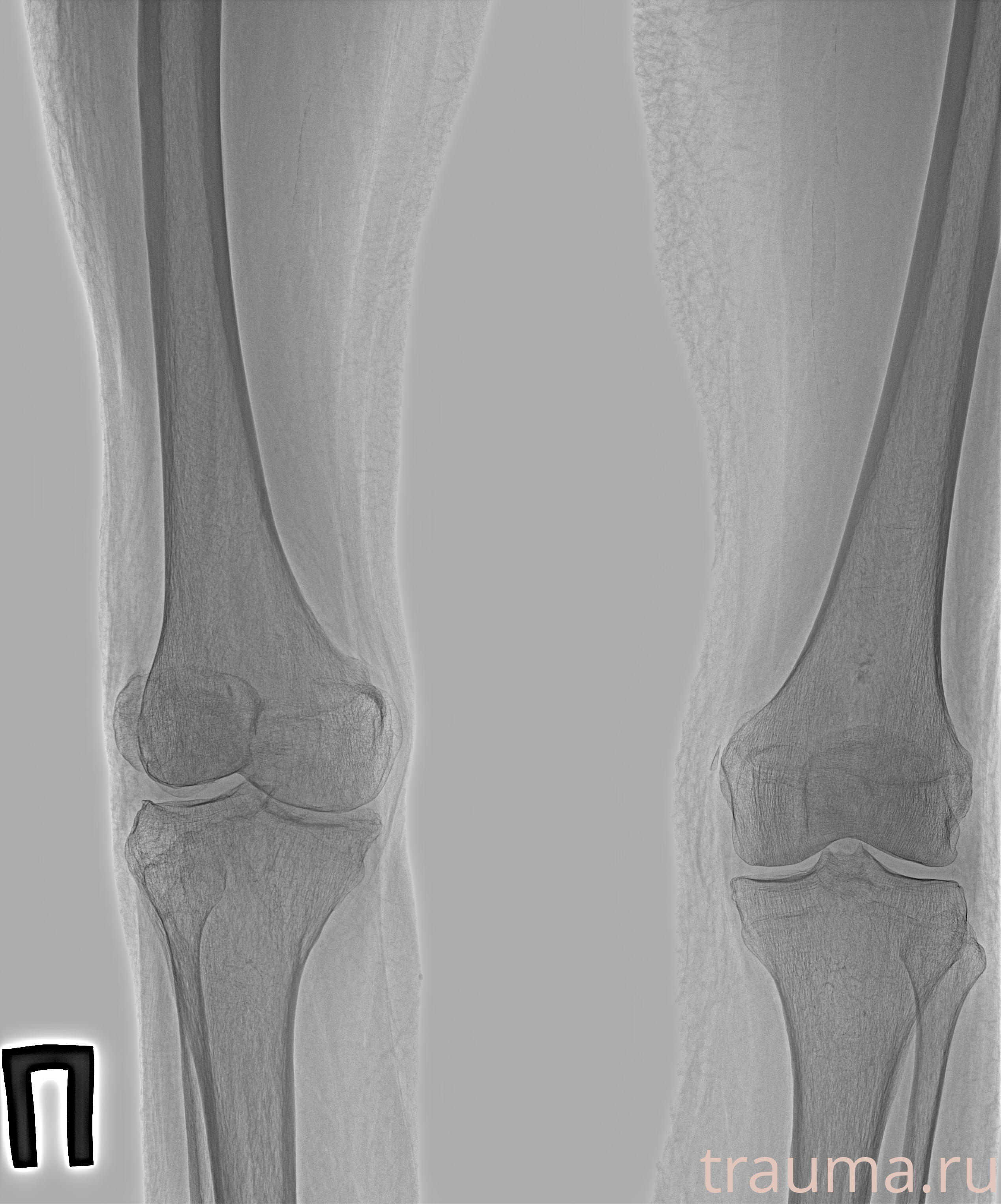 Рентген на дому: по вашему адресу приезжает врач-рентгенолог, травматолог-ортопед с мобильным рентгеновским аппаратом, проводит диагностику травмы или заболевания, делает необходимые рентгенограммы, дает рекомендации по дальнейшему лечению. Получить качественные снимки в домашних условиях возможно благодаря уникальной методике, разработанной МосРентген Центром для института  Склифосовского