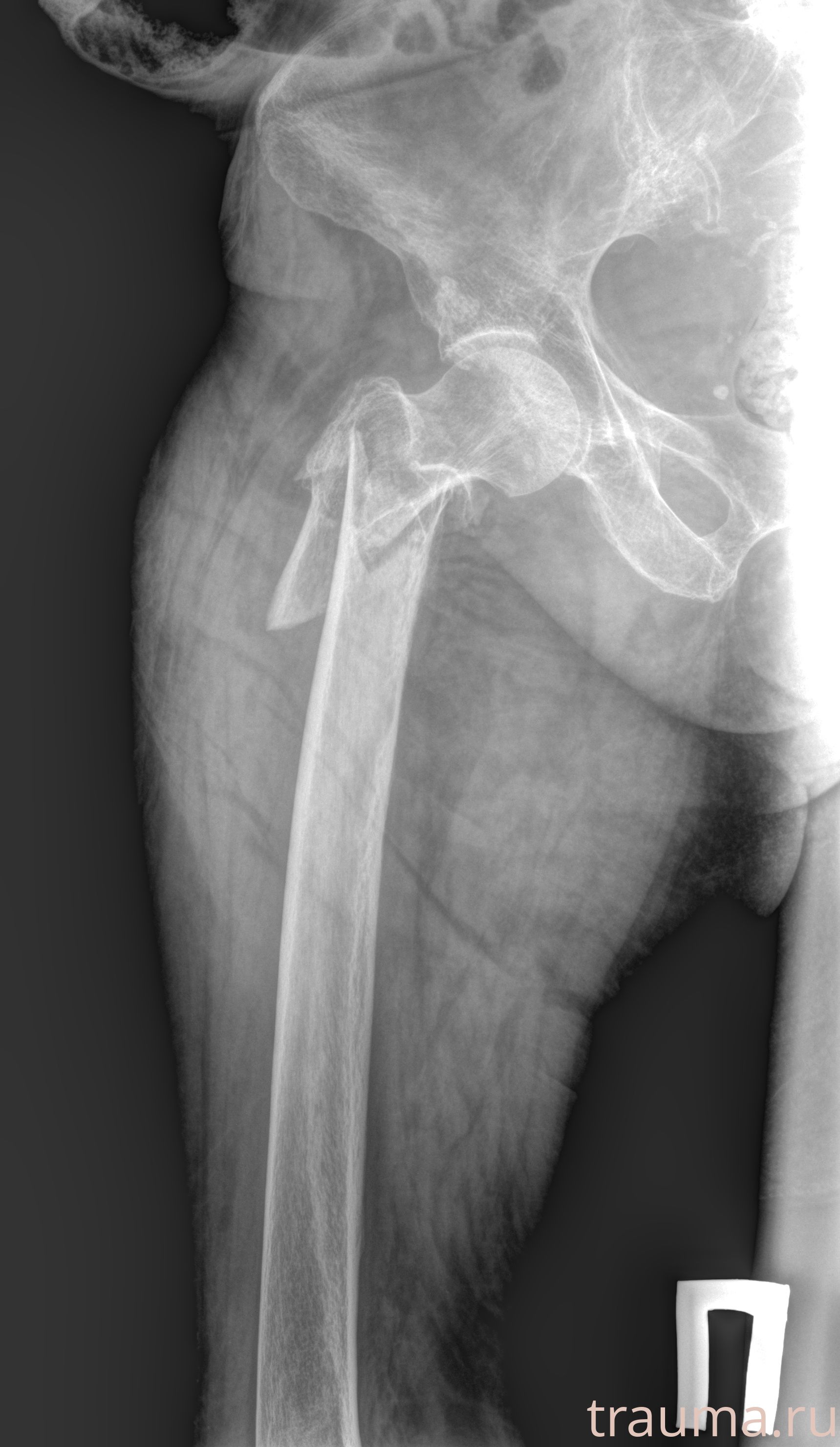 Рентген на дому: по вашему адресу приезжает врач-рентгенолог, травматолог-ортопед с мобильным рентгеновским аппаратом, проводит диагностику травмы или заболевания, делает необходимые рентгенограммы, дает рекомендации по дальнейшему лечению. Получить качественные снимки в домашних условиях возможно благодаря уникальной методике, разработанной МосРентген Центром для института  Склифосовского