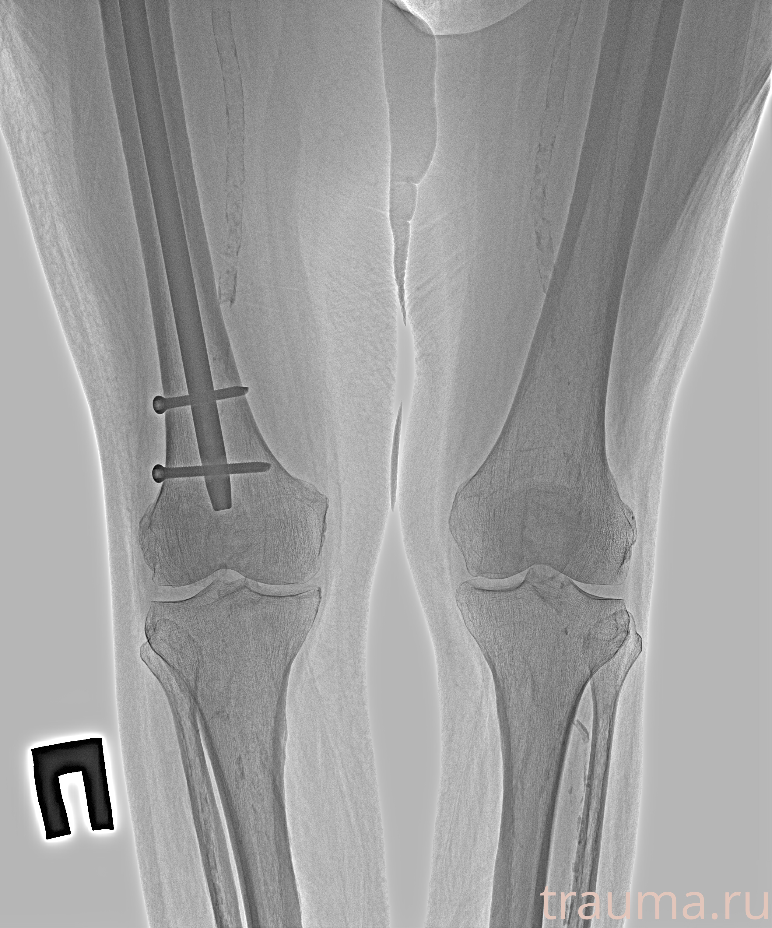 Рентген на дому: по вашему адресу приезжает врач-рентгенолог, травматолог-ортопед с мобильным рентгеновским аппаратом, проводит диагностику травмы или заболевания, делает необходимые рентгенограммы, дает рекомендации по дальнейшему лечению. Получить качественные снимки в домашних условиях возможно благодаря уникальной методике, разработанной МосРентген Центром для института  Склифосовского