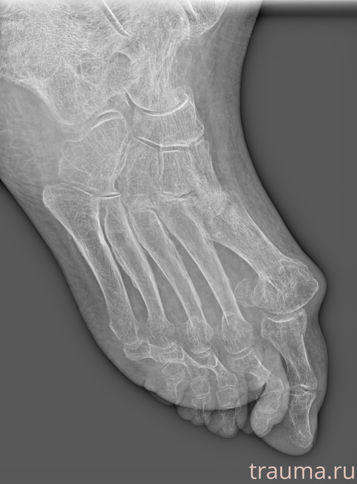 Рентген на дому: по вашему адресу приезжает врач-рентгенолог, травматолог-ортопед с мобильным рентгеновским аппаратом, проводит диагностику травмы или заболевания, делает необходимые рентгенограммы, дает рекомендации по дальнейшему лечению. Получить качественные снимки в домашних условиях возможно благодаря уникальной методике, разработанной МосРентген Центром для института  Склифосовского