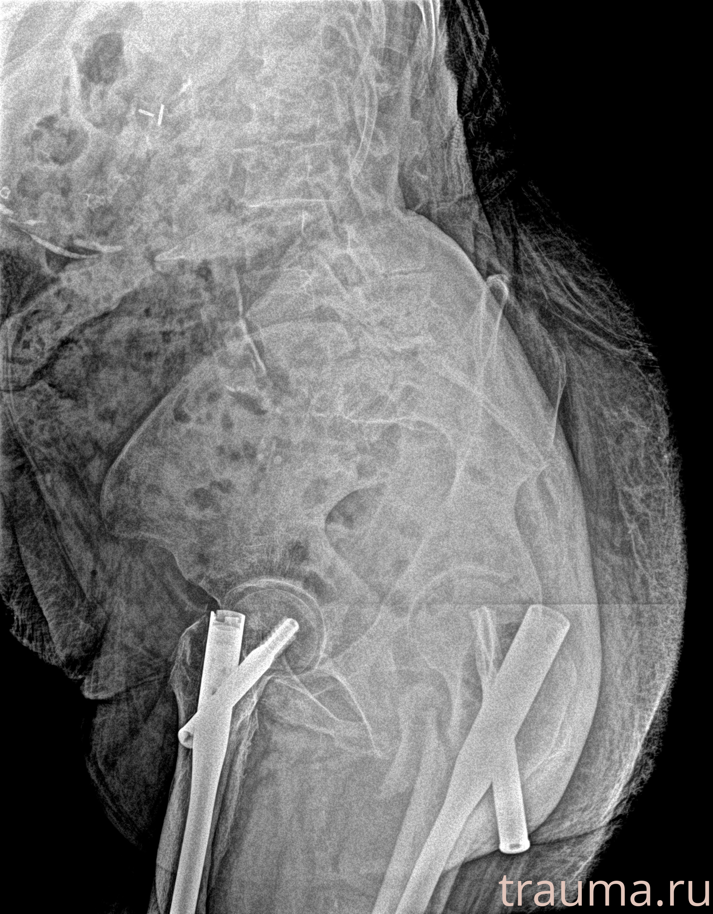 Рентген на дому: по вашему адресу приезжает врач-рентгенолог, травматолог-ортопед с мобильным рентгеновским аппаратом, проводит диагностику травмы или заболевания, делает необходимые рентгенограммы, дает рекомендации по дальнейшему лечению. Получить качественные снимки в домашних условиях возможно благодаря уникальной методике, разработанной МосРентген Центром для института  Склифосовского