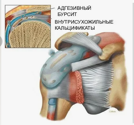 Надостной мышцы бурсит