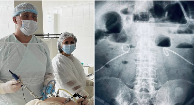 В Подмосковье спасли пациента, проглотившего бор на приеме у стоматолога