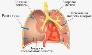 Коллапс 