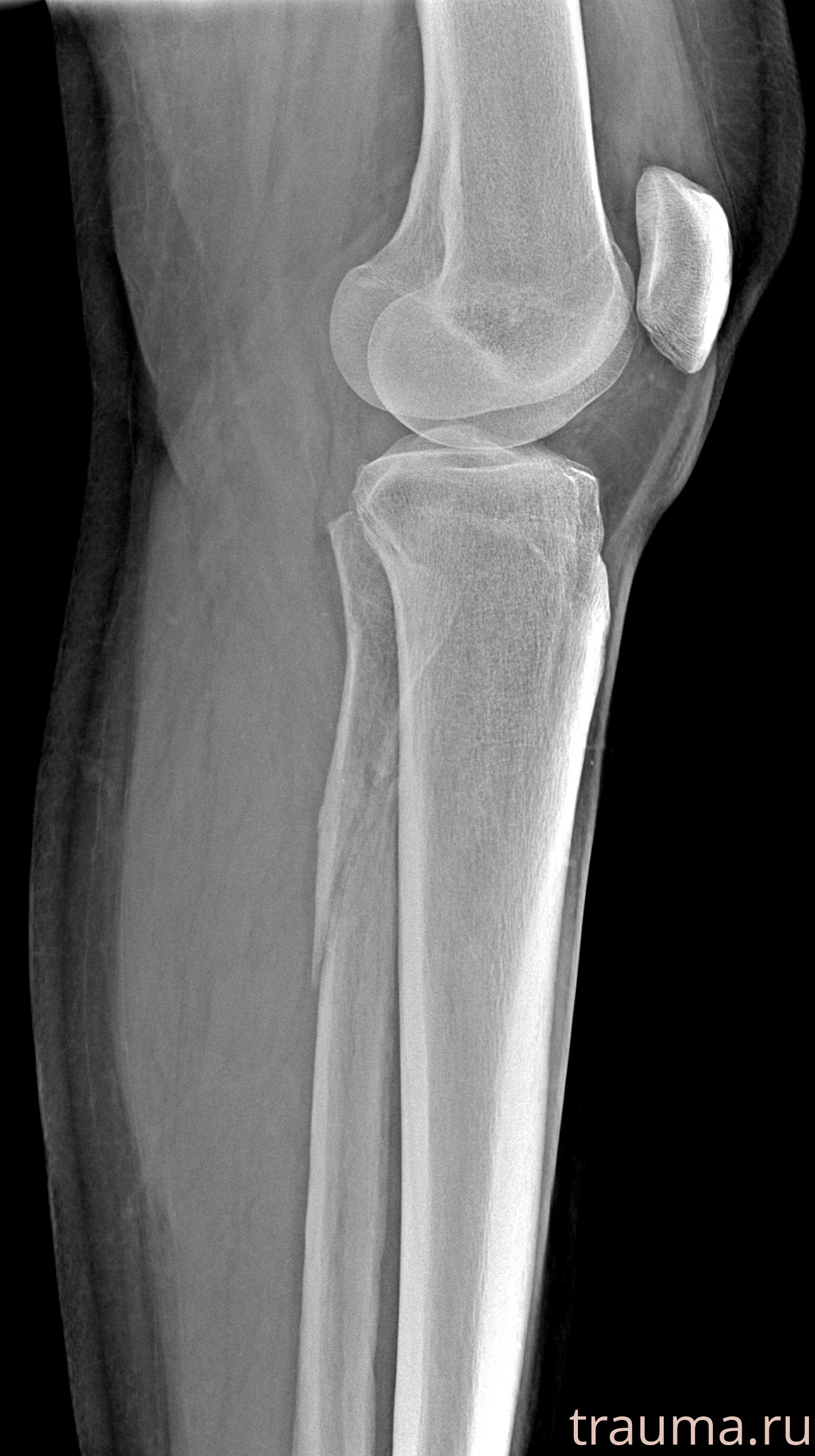 Рентген на дому: по вашему адресу приезжает врач-рентгенолог, травматолог-ортопед с мобильным рентгеновским аппаратом, проводит диагностику травмы или заболевания, делает необходимые рентгенограммы, дает рекомендации по дальнейшему лечению. Получить качественные снимки в домашних условиях возможно благодаря уникальной методике, разработанной МосРентген Центром для института  Склифосовского