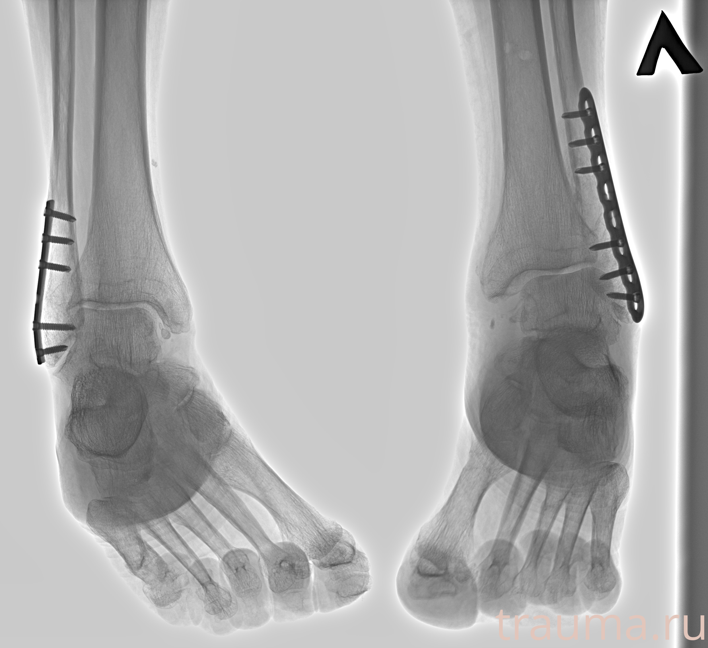 Рентген на дому: по вашему адресу приезжает врач-рентгенолог, травматолог-ортопед с мобильным рентгеновским аппаратом, проводит диагностику травмы или заболевания, делает необходимые рентгенограммы, дает рекомендации по дальнейшему лечению. Получить качественные снимки в домашних условиях возможно благодаря уникальной методике, разработанной МосРентген Центром для института  Склифосовского