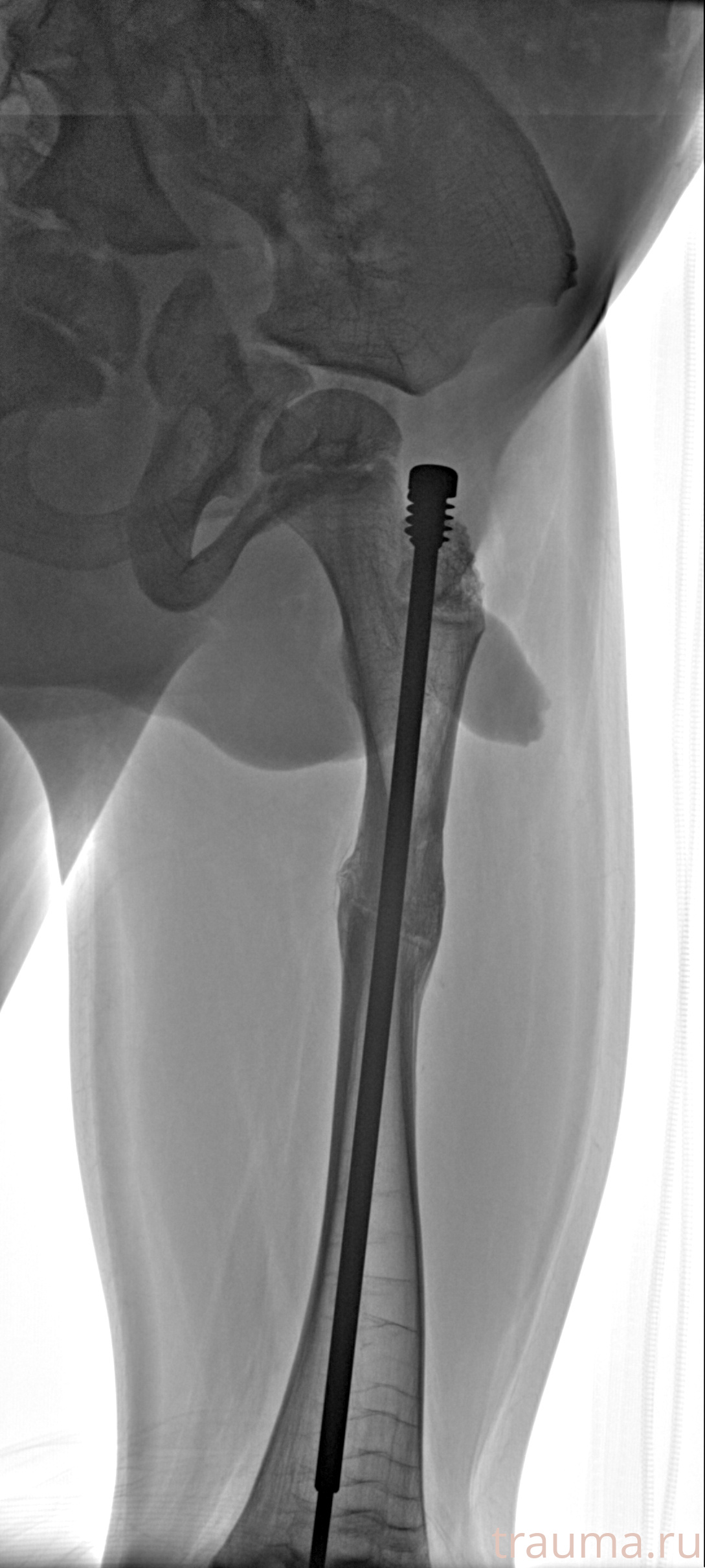 Рентген на дому: по вашему адресу приезжает врач-рентгенолог, травматолог-ортопед с мобильным рентгеновским аппаратом, проводит диагностику травмы или заболевания, делает необходимые рентгенограммы, дает рекомендации по дальнейшему лечению. Получить качественные снимки в домашних условиях возможно благодаря уникальной методике, разработанной МосРентген Центром для института  Склифосовского