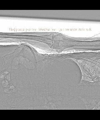 Цифровой рентген при непроходимости кишечника