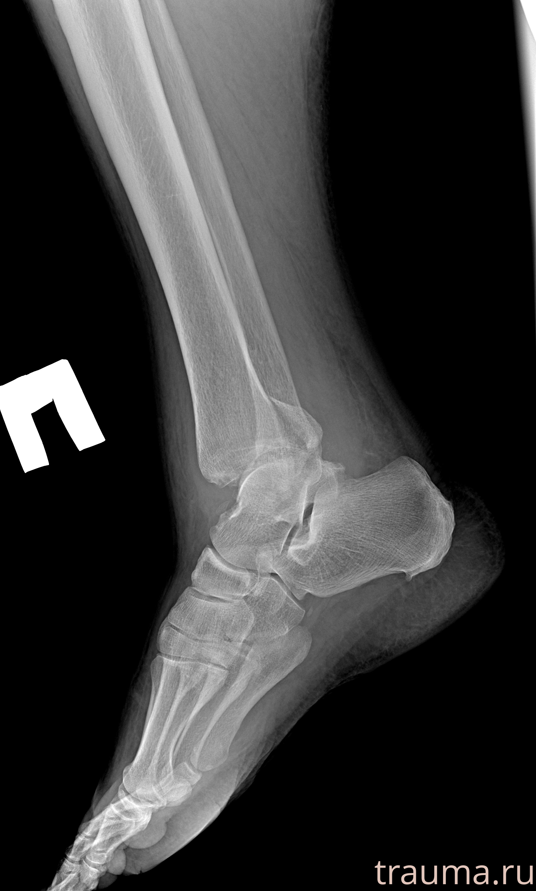 Рентген на дому: по вашему адресу приезжает врач-рентгенолог, травматолог-ортопед с мобильным рентгеновским аппаратом, проводит диагностику травмы или заболевания, делает необходимые рентгенограммы, дает рекомендации по дальнейшему лечению. Получить качественные снимки в домашних условиях возможно благодаря уникальной методике, разработанной МосРентген Центром для института  Склифосовского