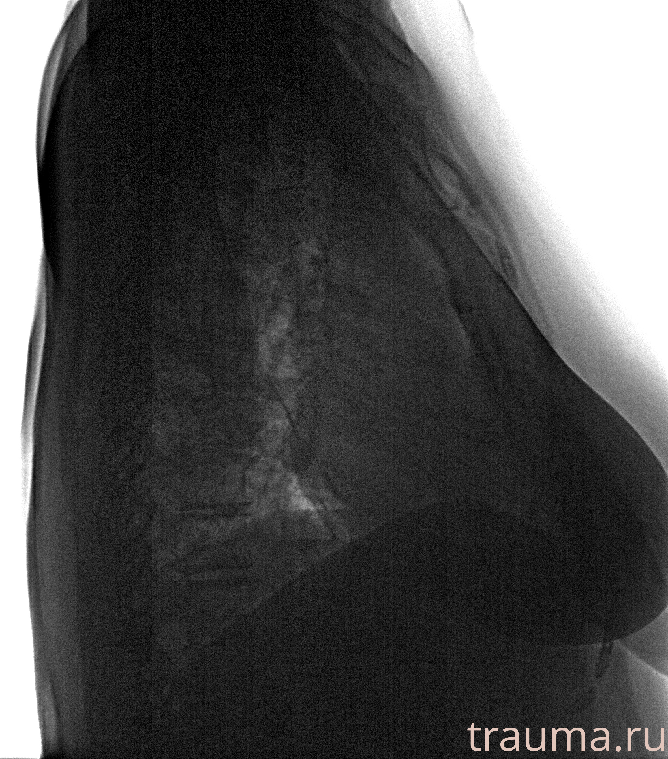 Рентген на дому: по вашему адресу приезжает врач-рентгенолог, травматолог-ортопед с мобильным рентгеновским аппаратом, проводит диагностику травмы или заболевания, делает необходимые рентгенограммы, дает рекомендации по дальнейшему лечению. Получить качественные снимки в домашних условиях возможно благодаря уникальной методике, разработанной МосРентген Центром для института  Склифосовского