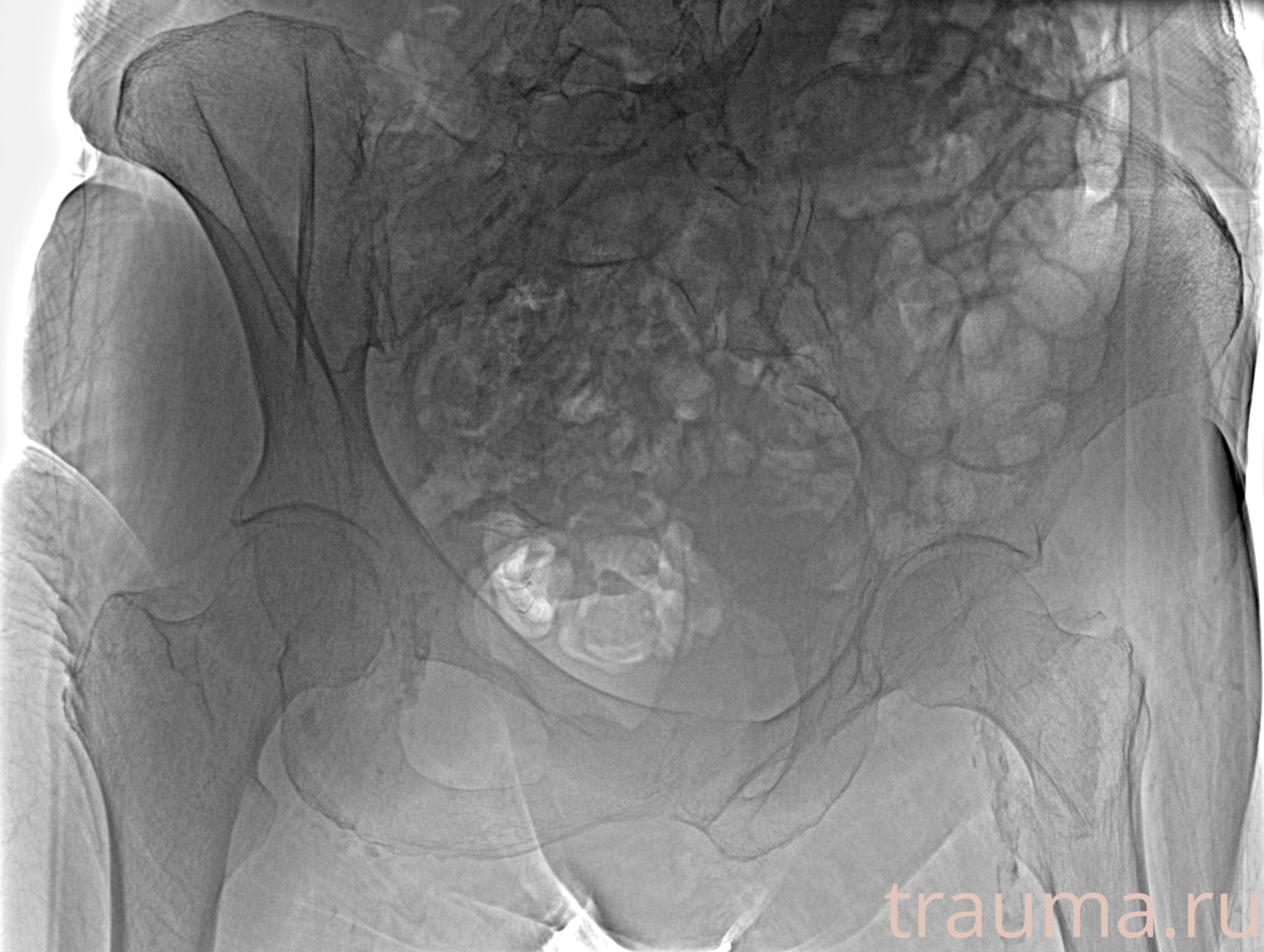 Рентген на дому: по вашему адресу приезжает врач-рентгенолог, травматолог-ортопед с мобильным рентгеновским аппаратом, проводит диагностику травмы или заболевания, делает необходимые рентгенограммы, дает рекомендации по дальнейшему лечению. Получить качественные снимки в домашних условиях возможно благодаря уникальной методике, разработанной МосРентген Центром для института  Склифосовского