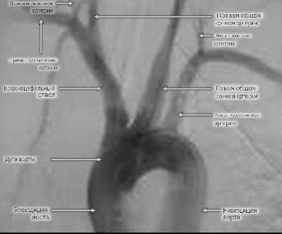 Отконтрастированные артерии, отходящие от аорты.