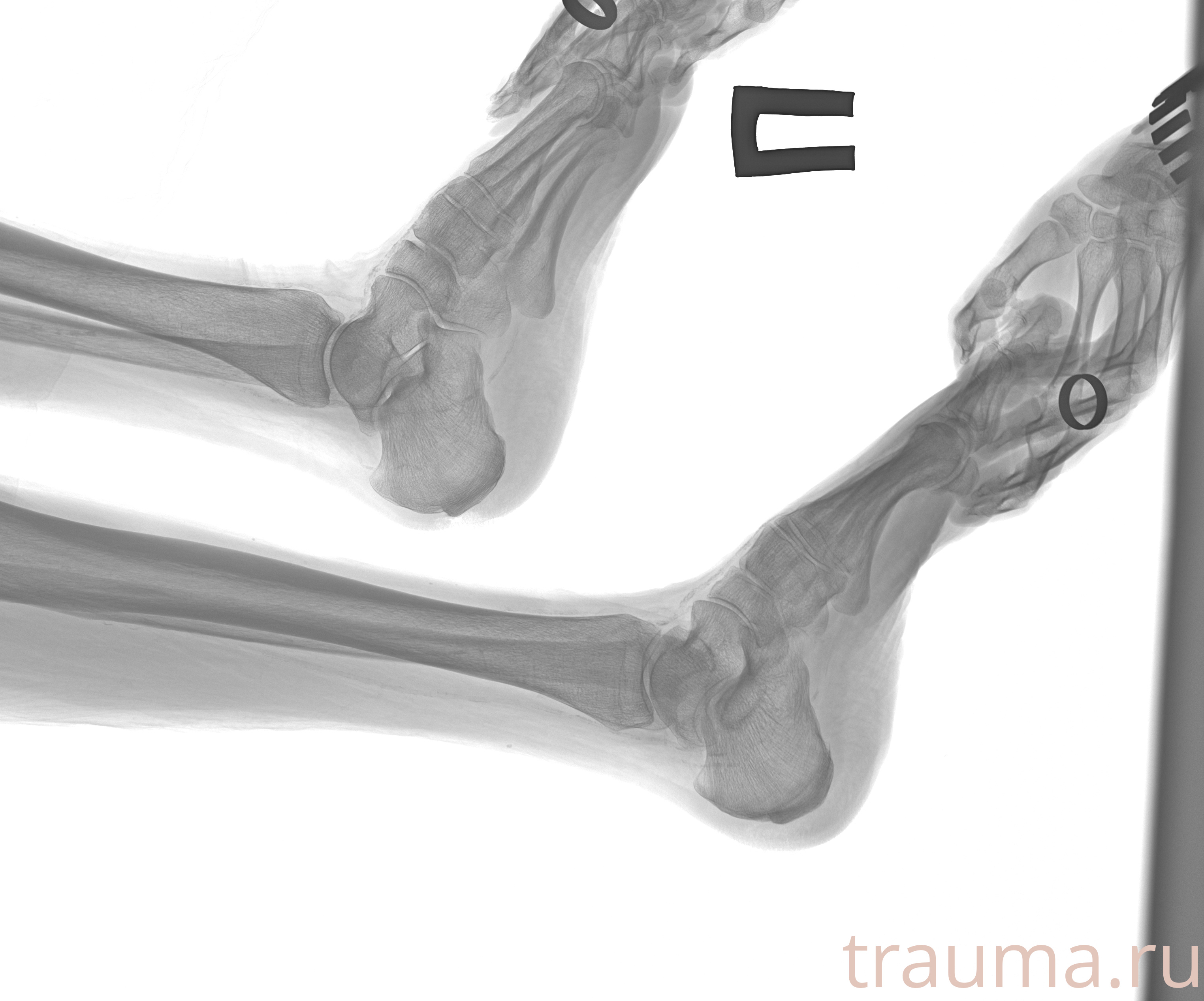 Рентген на дому: по вашему адресу приезжает врач-рентгенолог, травматолог-ортопед с мобильным рентгеновским аппаратом, проводит диагностику травмы или заболевания, делает необходимые рентгенограммы, дает рекомендации по дальнейшему лечению. Получить качественные снимки в домашних условиях возможно благодаря уникальной методике, разработанной МосРентген Центром для института  Склифосовского