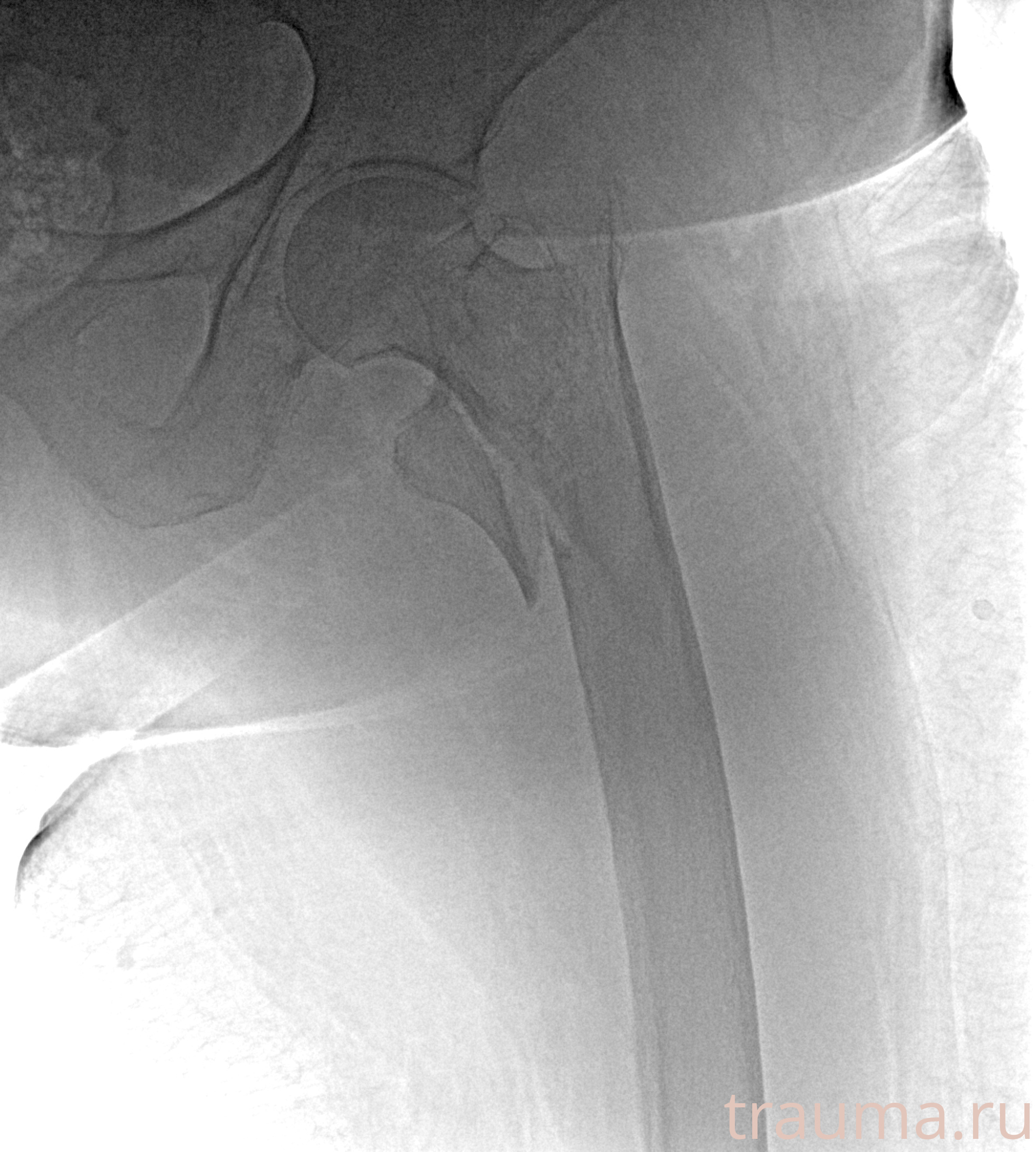 Рентген на дому: по вашему адресу приезжает врач-рентгенолог, травматолог-ортопед с мобильным рентгеновским аппаратом, проводит диагностику травмы или заболевания, делает необходимые рентгенограммы, дает рекомендации по дальнейшему лечению. Получить качественные снимки в домашних условиях возможно благодаря уникальной методике, разработанной МосРентген Центром для института  Склифосовского