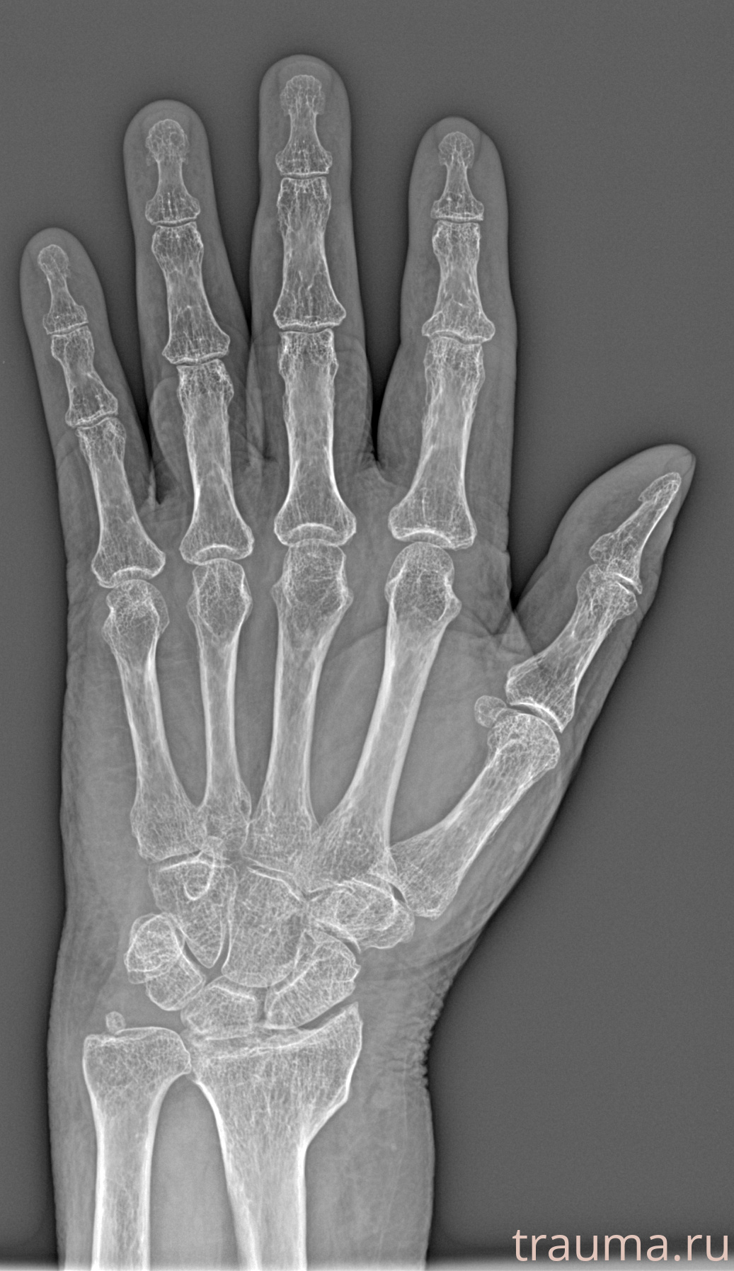 Рентген на дому: по вашему адресу приезжает врач-рентгенолог, травматолог-ортопед с мобильным рентгеновским аппаратом, проводит диагностику травмы или заболевания, делает необходимые рентгенограммы, дает рекомендации по дальнейшему лечению. Получить качественные снимки в домашних условиях возможно благодаря уникальной методике, разработанной МосРентген Центром для института  Склифосовского