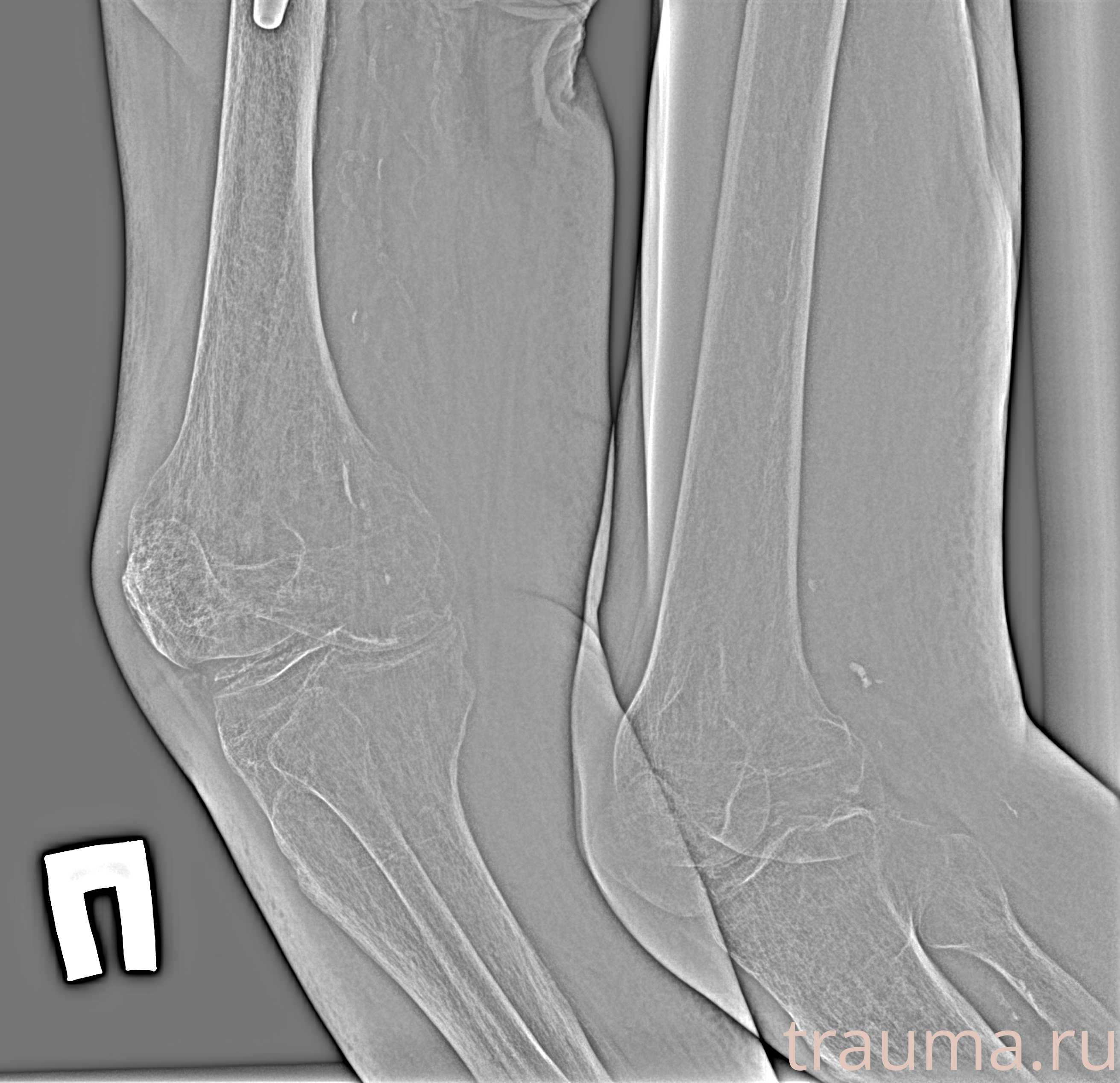Рентген на дому: по вашему адресу приезжает врач-рентгенолог, травматолог-ортопед с мобильным рентгеновским аппаратом, проводит диагностику травмы или заболевания, делает необходимые рентгенограммы, дает рекомендации по дальнейшему лечению. Получить качественные снимки в домашних условиях возможно благодаря уникальной методике, разработанной МосРентген Центром для института  Склифосовского