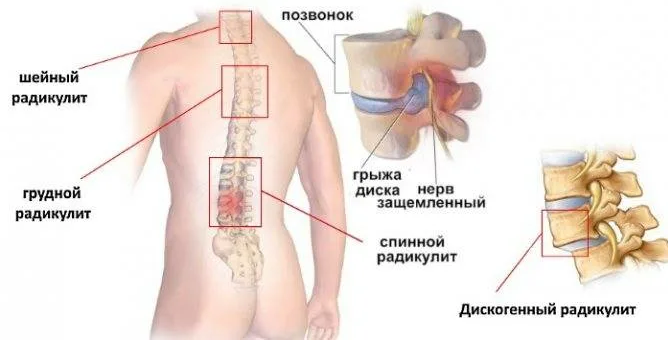 Как быстро снять радикулит