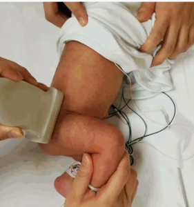 Ультразвуковая диагностика дисплазии тазобедренного сустава у детей раннего возраста 