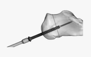 Опыт применения противошоковых канюлированных винтов при тяжёлых травмах таза