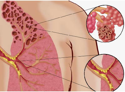 Попкорновая болезнь