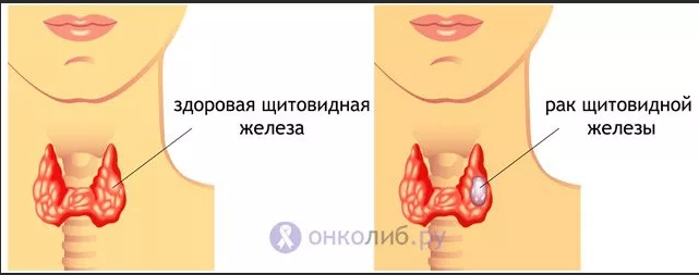 Как выглядит рак щитовидки