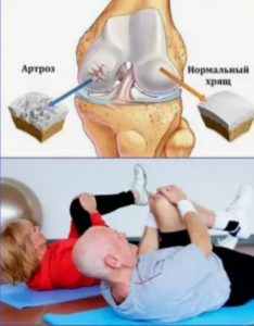 Методология оценки ходьбы для выявления усталостных и декомпенсаторных механизмов работы опорно-двигательной системы у больных коксартрозом