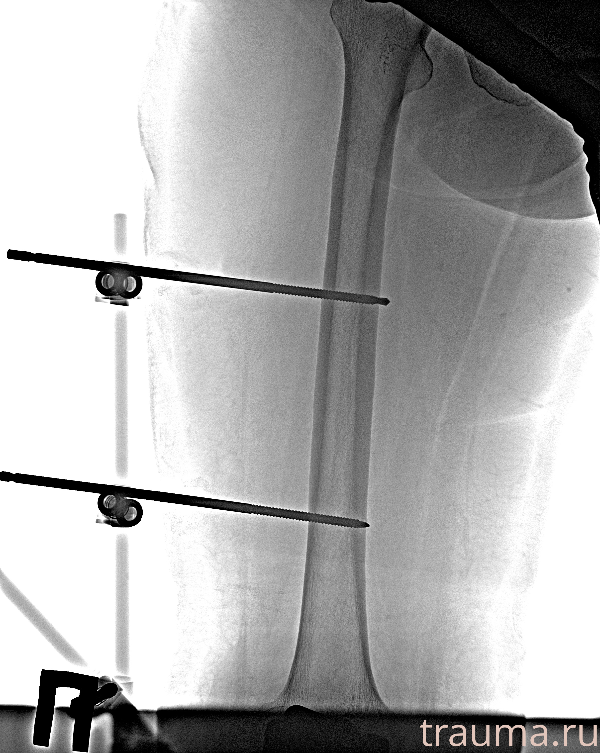 Рентген на дому: по вашему адресу приезжает врач-рентгенолог, травматолог-ортопед с мобильным рентгеновским аппаратом, проводит диагностику травмы или заболевания, делает необходимые рентгенограммы, дает рекомендации по дальнейшему лечению. Получить качественные снимки в домашних условиях возможно благодаря уникальной методике, разработанной МосРентген Центром для института  Склифосовского
