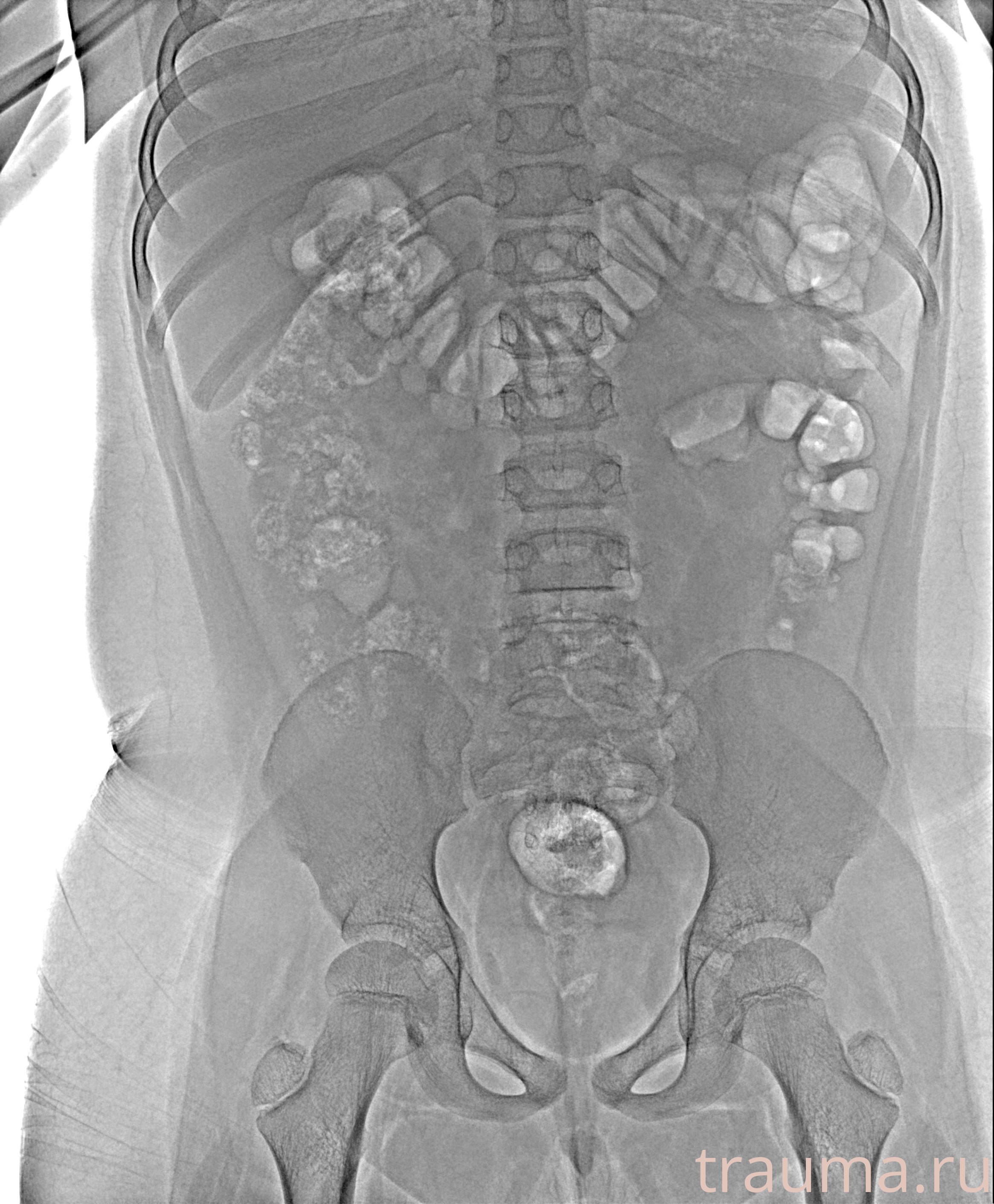 Рентген на дому: по вашему адресу приезжает врач-рентгенолог, травматолог-ортопед с мобильным рентгеновским аппаратом, проводит диагностику травмы или заболевания, делает необходимые рентгенограммы, дает рекомендации по дальнейшему лечению. Получить качественные снимки в домашних условиях возможно благодаря уникальной методике, разработанной МосРентген Центром для института  Склифосовского