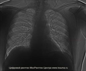 Бронхиолиты – возможности и задачи  рентгенологической диагностики