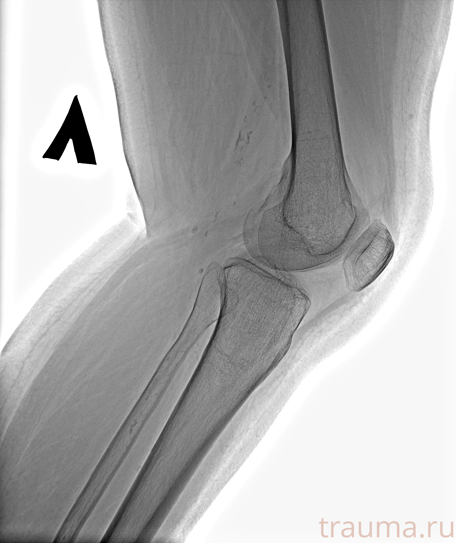 Рентген на дому: по вашему адресу приезжает врач-рентгенолог, травматолог-ортопед с мобильным рентгеновским аппаратом, проводит диагностику травмы или заболевания, делает необходимые рентгенограммы, дает рекомендации по дальнейшему лечению. Получить качественные снимки в домашних условиях возможно благодаря уникальной методике, разработанной МосРентген Центром для института  Склифосовского