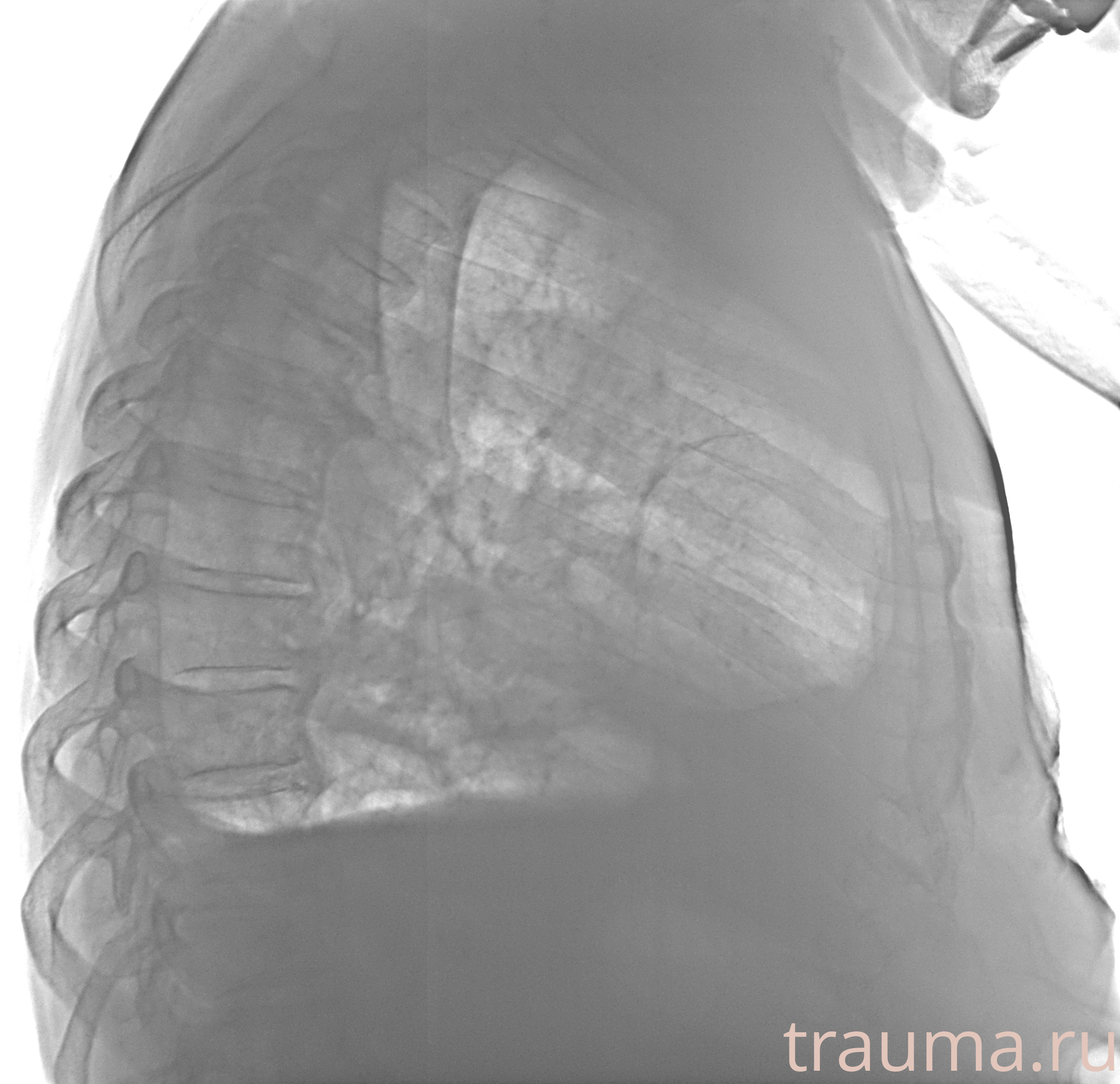 Рентген на дому: по вашему адресу приезжает врач-рентгенолог, травматолог-ортопед с мобильным рентгеновским аппаратом, проводит диагностику травмы или заболевания, делает необходимые рентгенограммы, дает рекомендации по дальнейшему лечению. Получить качественные снимки в домашних условиях возможно благодаря уникальной методике, разработанной МосРентген Центром для института  Склифосовского