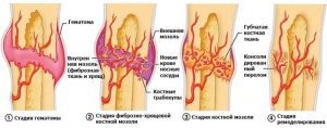Особенности остеорепаративных процессов при заживлении экспериментальных переломов с различной степенью травматизации костного мозга