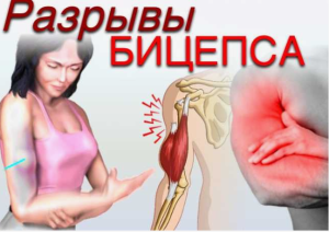 Оказание специализированной помощи пациентам с разрывом дистального сухожилия двуглавой мышцы плеча: диагностика и алгоритм лечения Оказание специализированной помощи пациентам с разрывом дистального сухожилия двуглавой мышцы плеча: диагностика и алгоритм лечения