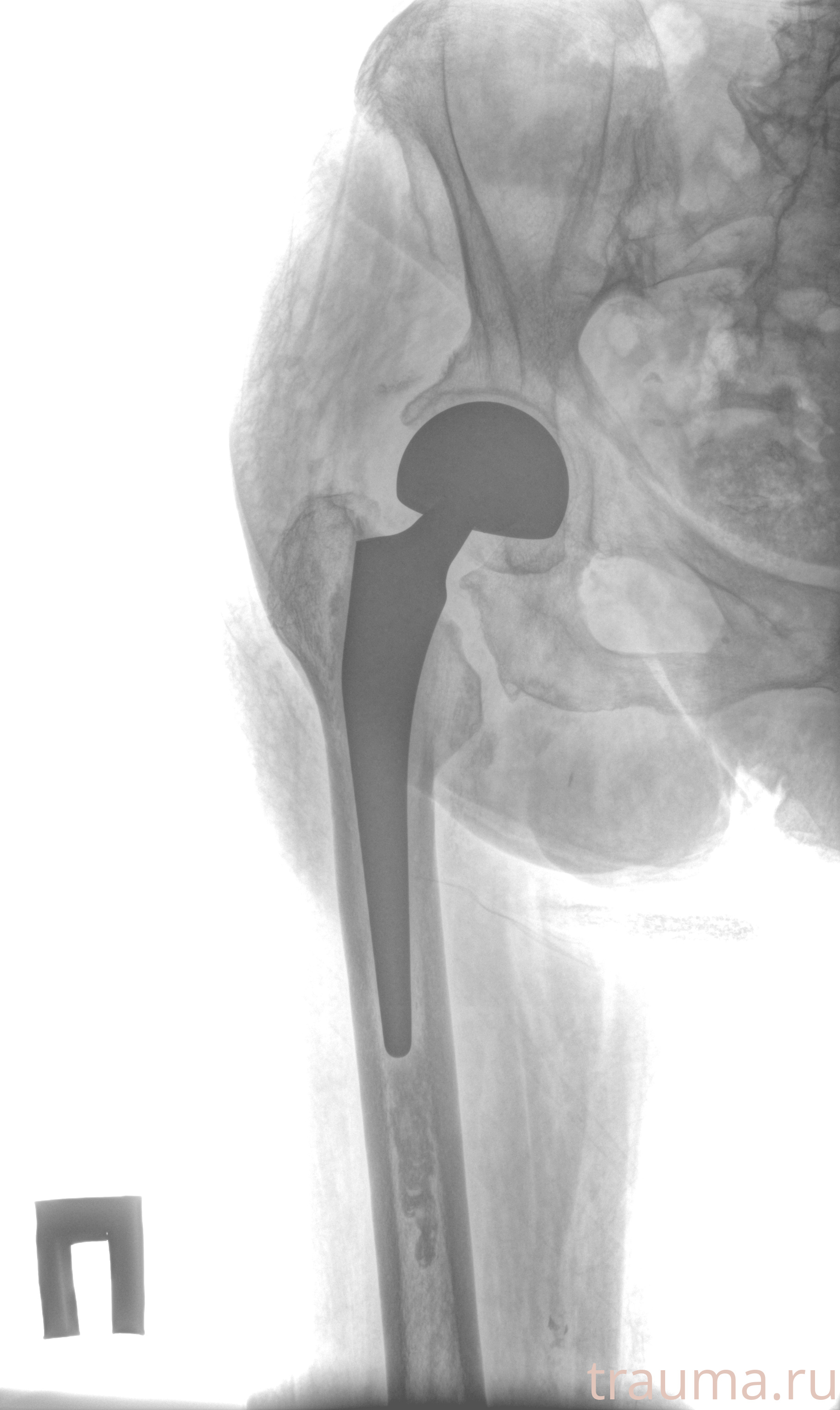 Рентген на дому: по вашему адресу приезжает врач-рентгенолог, травматолог-ортопед с мобильным рентгеновским аппаратом, проводит диагностику травмы или заболевания, делает необходимые рентгенограммы, дает рекомендации по дальнейшему лечению. Получить качественные снимки в домашних условиях возможно благодаря уникальной методике, разработанной МосРентген Центром для института  Склифосовского