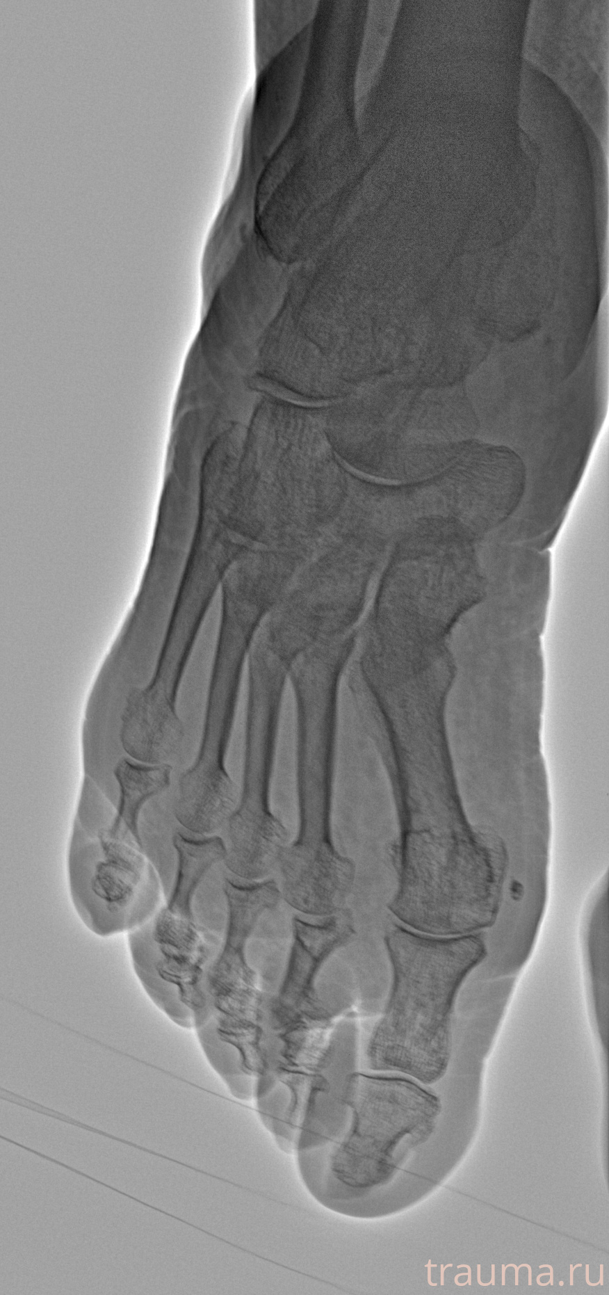 Рентген на дому: по вашему адресу приезжает врач-рентгенолог, травматолог-ортопед с мобильным рентгеновским аппаратом, проводит диагностику травмы или заболевания, делает необходимые рентгенограммы, дает рекомендации по дальнейшему лечению. Получить качественные снимки в домашних условиях возможно благодаря уникальной методике, разработанной МосРентген Центром для института  Склифосовского