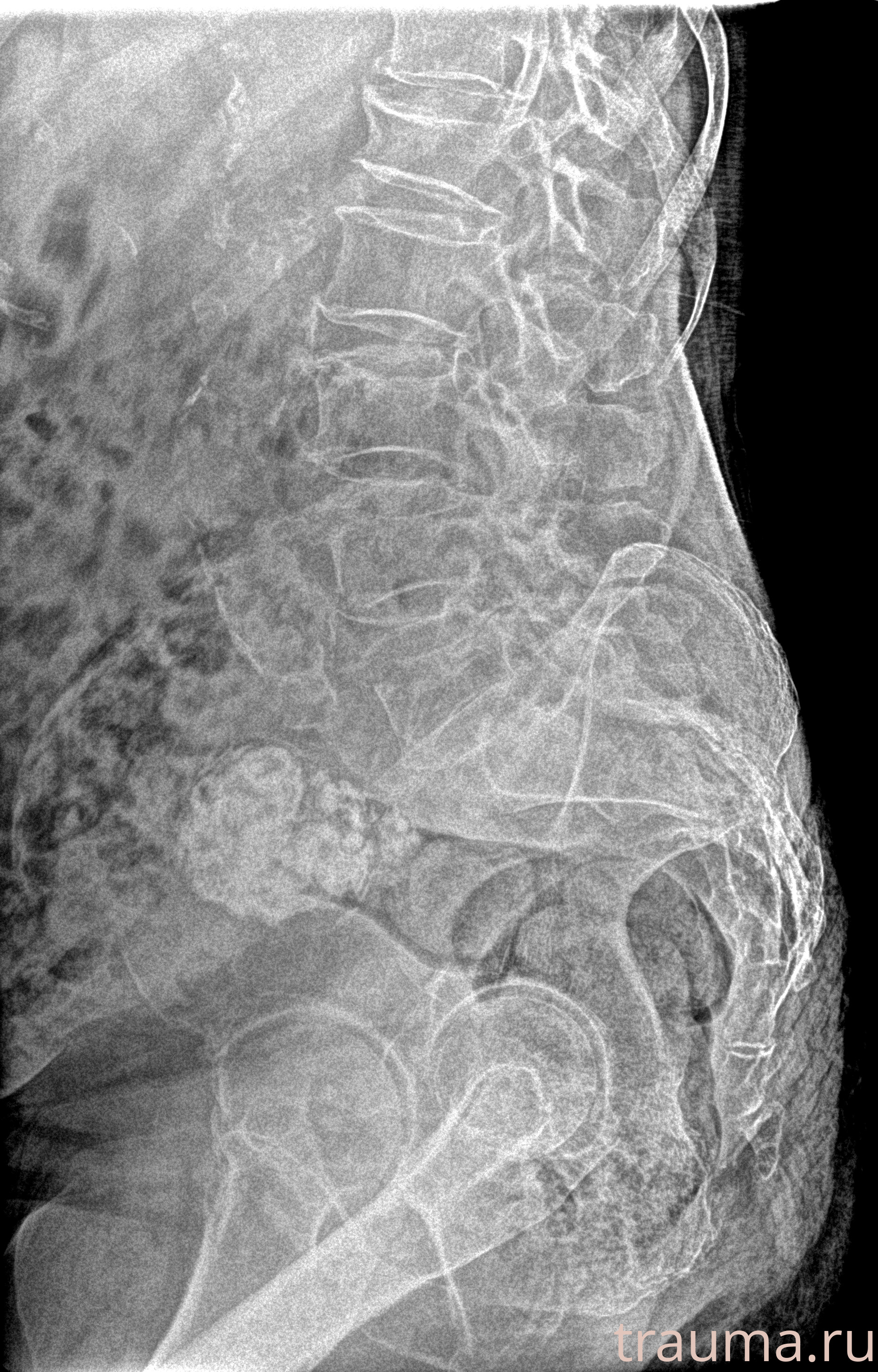 Рентген на дому: по вашему адресу приезжает врач-рентгенолог, травматолог-ортопед с мобильным рентгеновским аппаратом, проводит диагностику травмы или заболевания, делает необходимые рентгенограммы, дает рекомендации по дальнейшему лечению. Получить качественные снимки в домашних условиях возможно благодаря уникальной методике, разработанной МосРентген Центром для института  Склифосовского