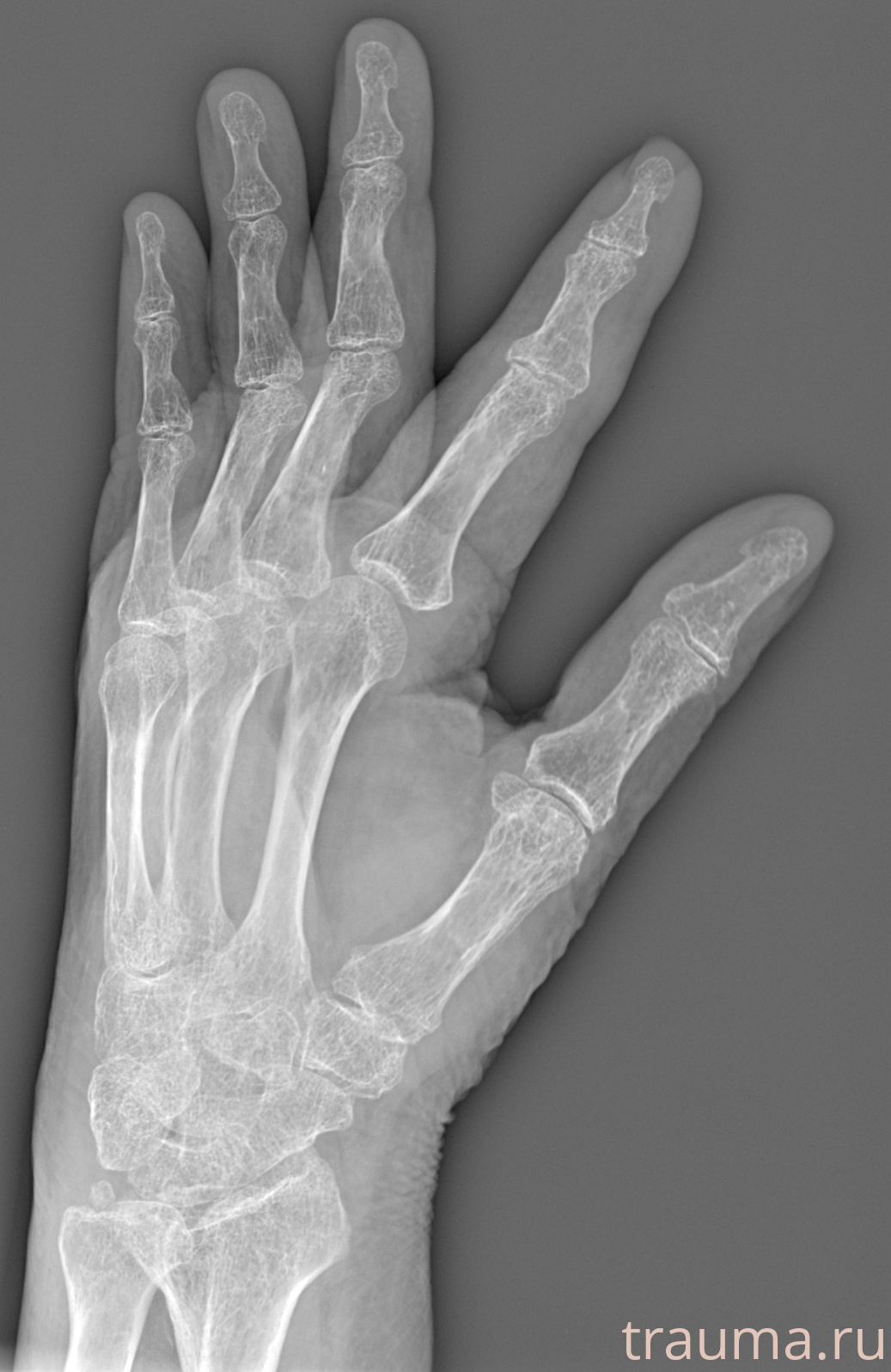 Рентген на дому: по вашему адресу приезжает врач-рентгенолог, травматолог-ортопед с мобильным рентгеновским аппаратом, проводит диагностику травмы или заболевания, делает необходимые рентгенограммы, дает рекомендации по дальнейшему лечению. Получить качественные снимки в домашних условиях возможно благодаря уникальной методике, разработанной МосРентген Центром для института  Склифосовского