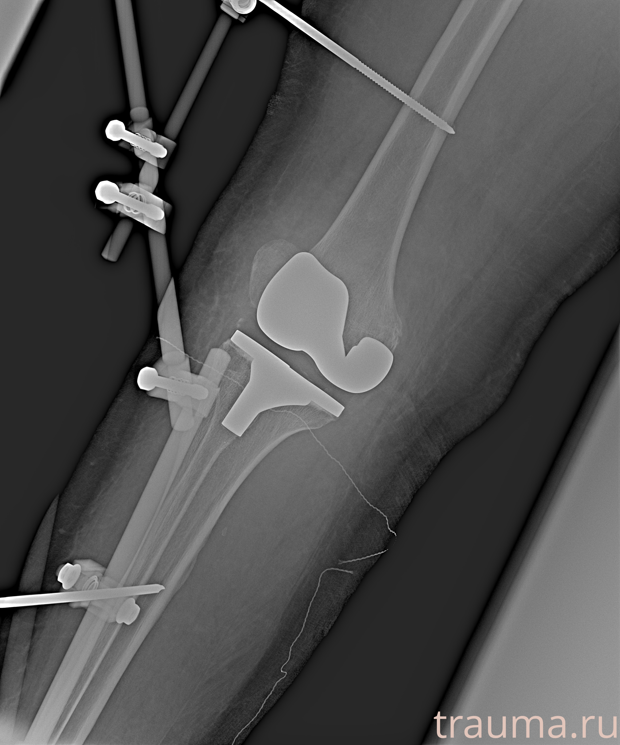 Рентген на дому: по вашему адресу приезжает врач-рентгенолог, травматолог-ортопед с мобильным рентгеновским аппаратом, проводит диагностику травмы или заболевания, делает необходимые рентгенограммы, дает рекомендации по дальнейшему лечению. Получить качественные снимки в домашних условиях возможно благодаря уникальной методике, разработанной МосРентген Центром для института  Склифосовского