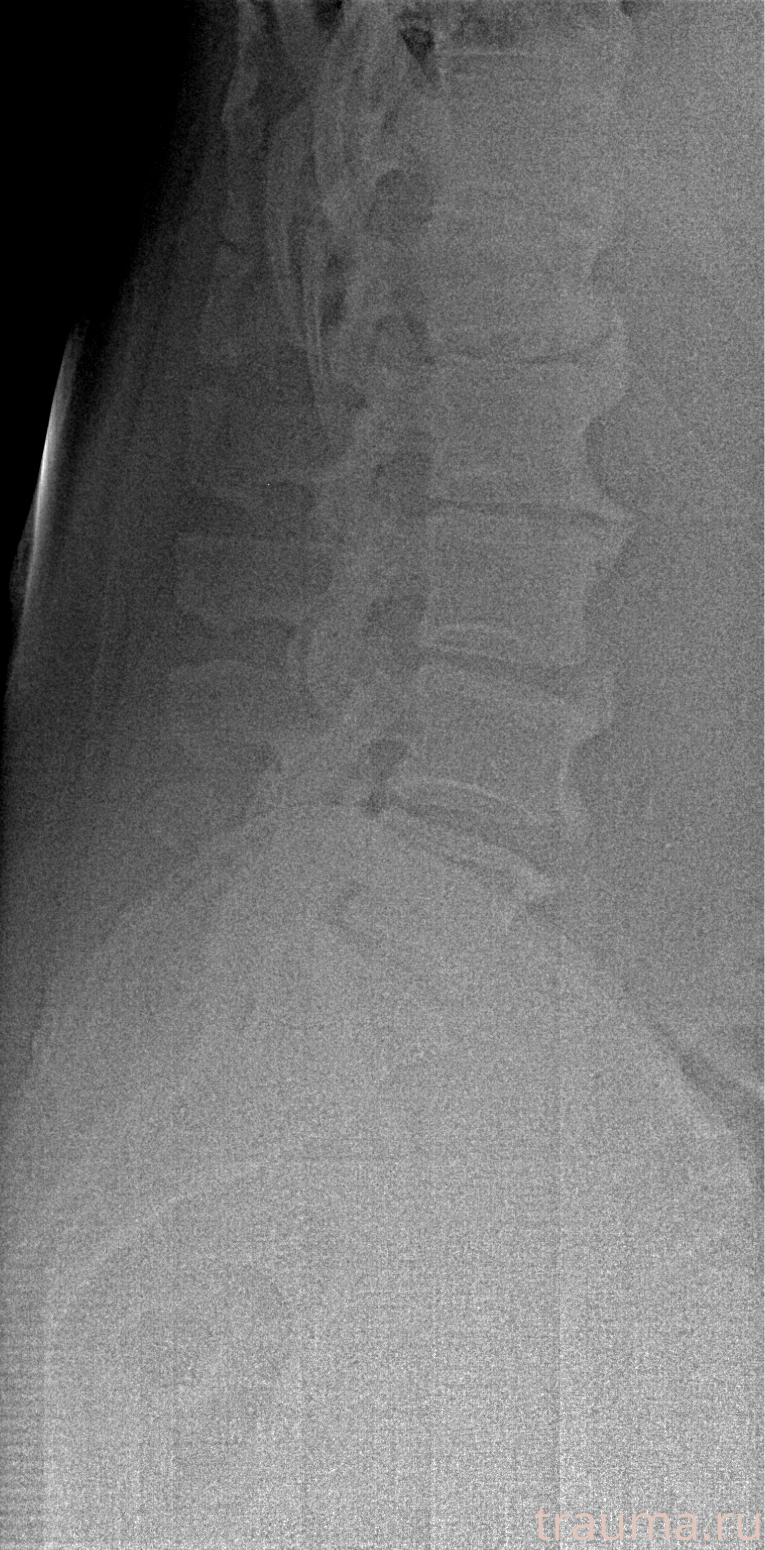 Рентген на дому: по вашему адресу приезжает врач-рентгенолог, травматолог-ортопед с мобильным рентгеновским аппаратом, проводит диагностику травмы или заболевания, делает необходимые рентгенограммы, дает рекомендации по дальнейшему лечению. Получить качественные снимки в домашних условиях возможно благодаря уникальной методике, разработанной МосРентген Центром для института  Склифосовского
