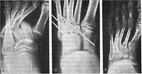 Чрескостный остеосинтез по Илизарову при лечении больных с вывихами костей стопы в суставах Шопара и Лисфранка