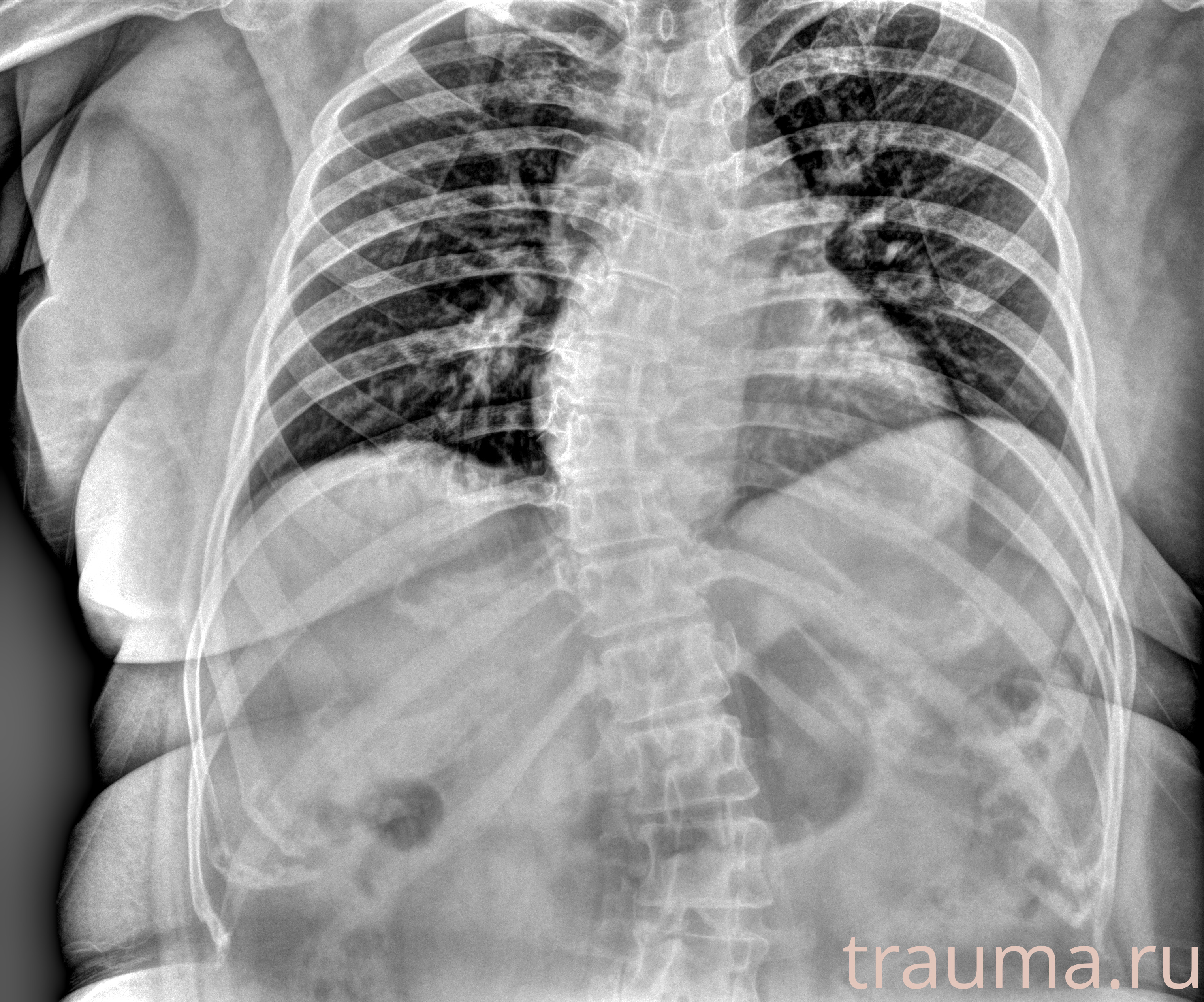 Рентген на дому: по вашему адресу приезжает врач-рентгенолог, травматолог-ортопед с мобильным рентгеновским аппаратом, проводит диагностику травмы или заболевания, делает необходимые рентгенограммы, дает рекомендации по дальнейшему лечению. Получить качественные снимки в домашних условиях возможно благодаря уникальной методике, разработанной МосРентген Центром для института  Склифосовского