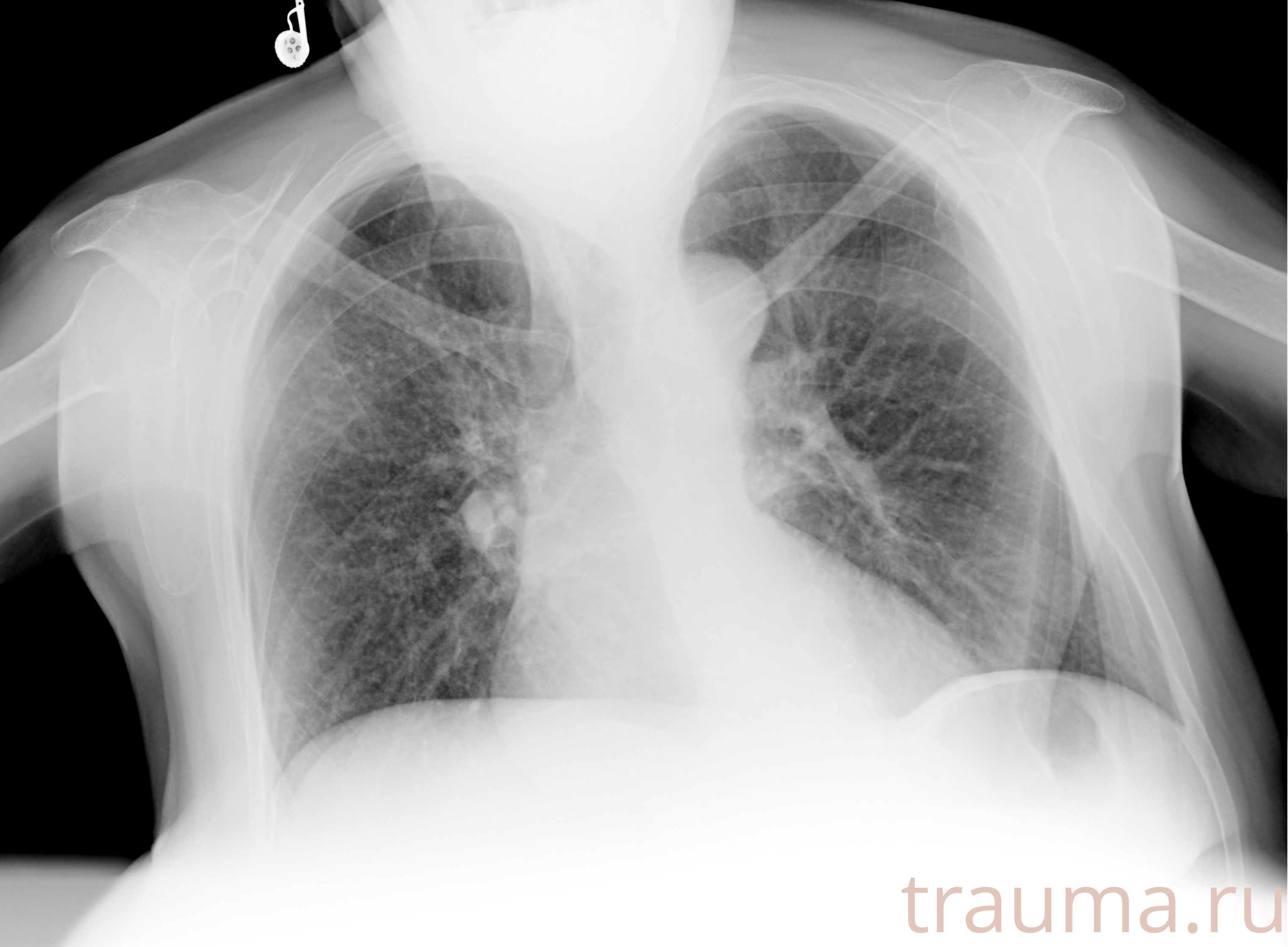 Рентген на дому: по вашему адресу приезжает врач-рентгенолог, травматолог-ортопед с мобильным рентгеновским аппаратом, проводит диагностику травмы или заболевания, делает необходимые рентгенограммы, дает рекомендации по дальнейшему лечению. Получить качественные снимки в домашних условиях возможно благодаря уникальной методике, разработанной МосРентген Центром для института  Склифосовского