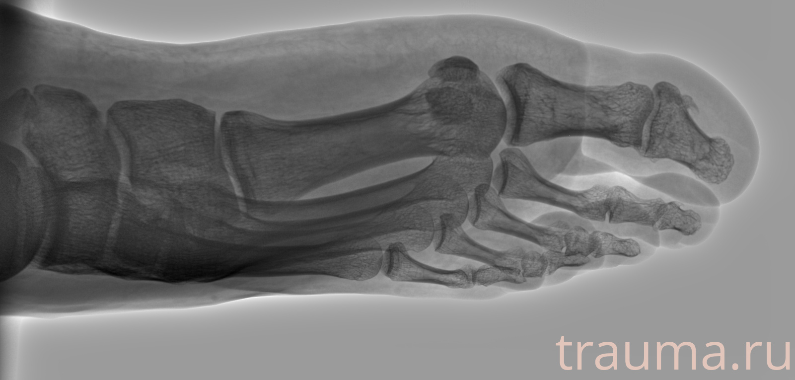 Рентген на дому: по вашему адресу приезжает врач-рентгенолог, травматолог-ортопед с мобильным рентгеновским аппаратом, проводит диагностику травмы или заболевания, делает необходимые рентгенограммы, дает рекомендации по дальнейшему лечению. Получить качественные снимки в домашних условиях возможно благодаря уникальной методике, разработанной МосРентген Центром для института  Склифосовского