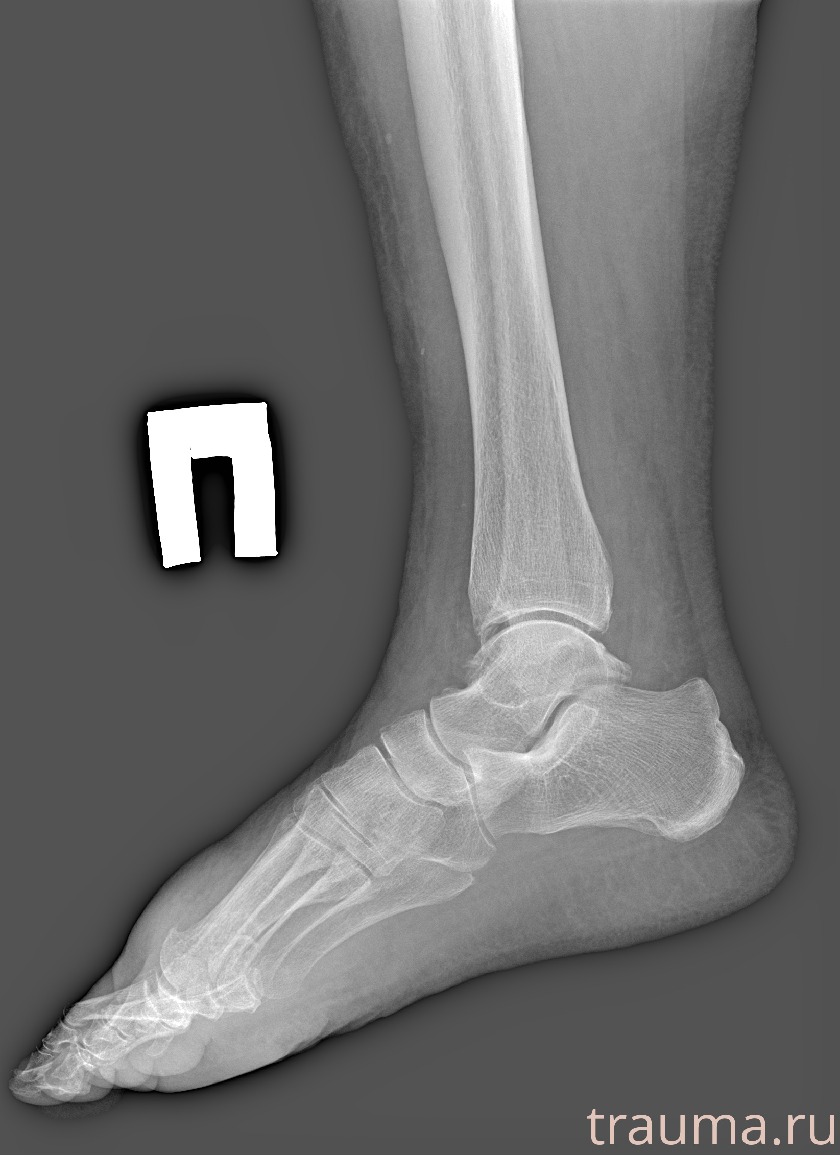 Рентген на дому: по вашему адресу приезжает врач-рентгенолог, травматолог-ортопед с мобильным рентгеновским аппаратом, проводит диагностику травмы или заболевания, делает необходимые рентгенограммы, дает рекомендации по дальнейшему лечению. Получить качественные снимки в домашних условиях возможно благодаря уникальной методике, разработанной МосРентген Центром для института  Склифосовского