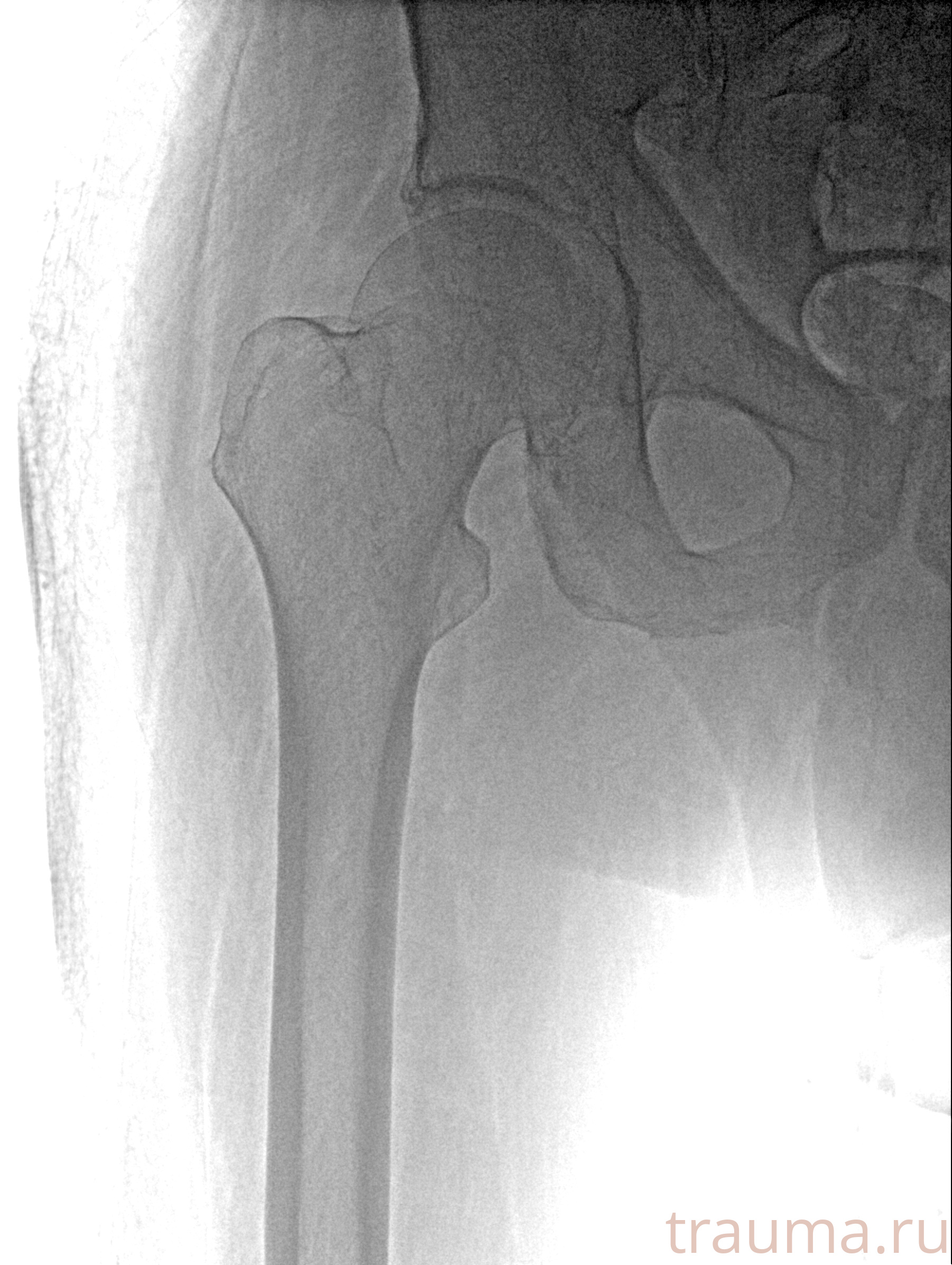 Рентген на дому: по вашему адресу приезжает врач-рентгенолог, травматолог-ортопед с мобильным рентгеновским аппаратом, проводит диагностику травмы или заболевания, делает необходимые рентгенограммы, дает рекомендации по дальнейшему лечению. Получить качественные снимки в домашних условиях возможно благодаря уникальной методике, разработанной МосРентген Центром для института  Склифосовского