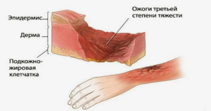 Способ прогноза исхода ожоговой травмы на основе математической модели