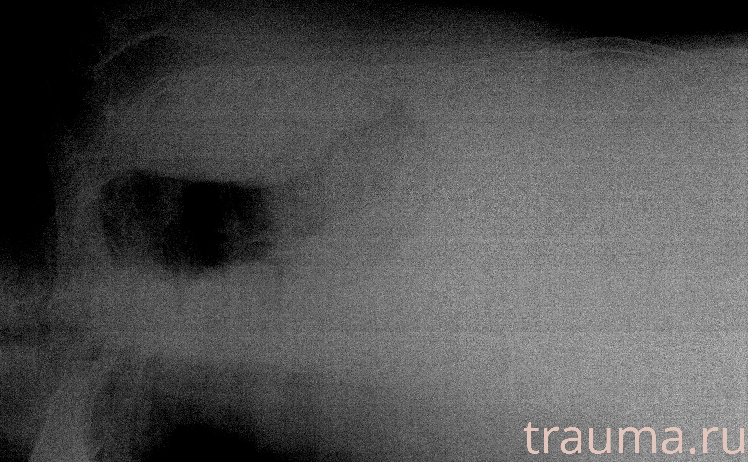 Рентген на дому: по вашему адресу приезжает врач-рентгенолог, травматолог-ортопед с мобильным рентгеновским аппаратом, проводит диагностику травмы или заболевания, делает необходимые рентгенограммы, дает рекомендации по дальнейшему лечению. Получить качественные снимки в домашних условиях возможно благодаря уникальной методике, разработанной МосРентген Центром для института  Склифосовского
