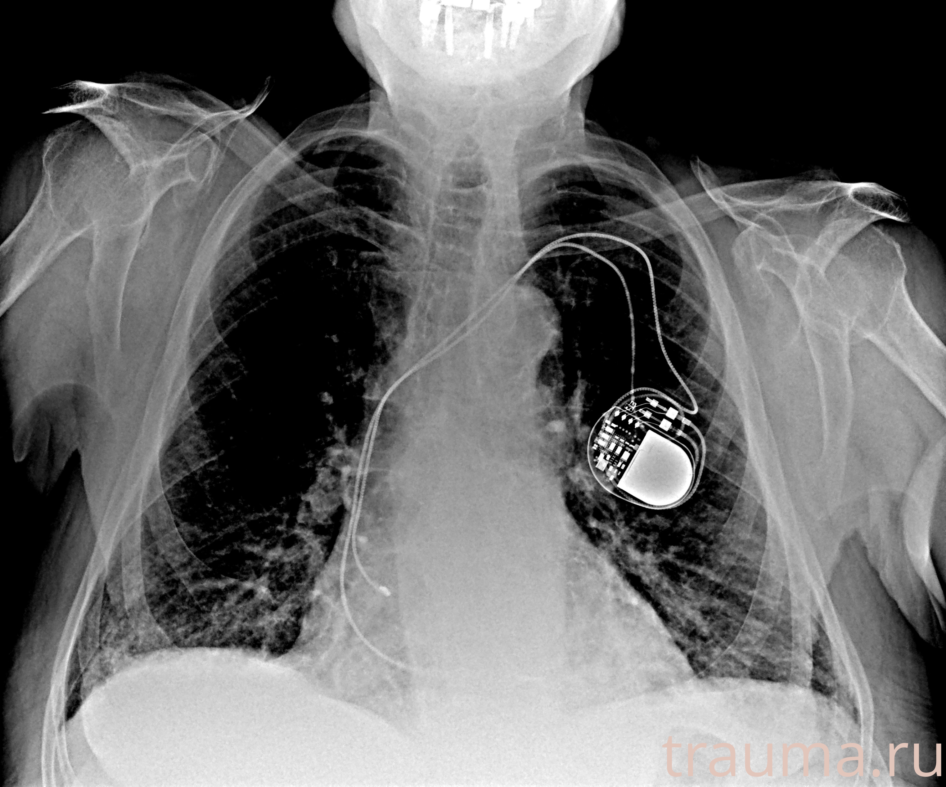 Рентген на дому: по вашему адресу приезжает врач-рентгенолог, травматолог-ортопед с мобильным рентгеновским аппаратом, проводит диагностику травмы или заболевания, делает необходимые рентгенограммы, дает рекомендации по дальнейшему лечению. Получить качественные снимки в домашних условиях возможно благодаря уникальной методике, разработанной МосРентген Центром для института  Склифосовского