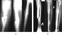 Чрескостный остеосинтез по Илизарову при лечении пострадавших с закрытыми диафизарными оскольчатыми переломами костей голени