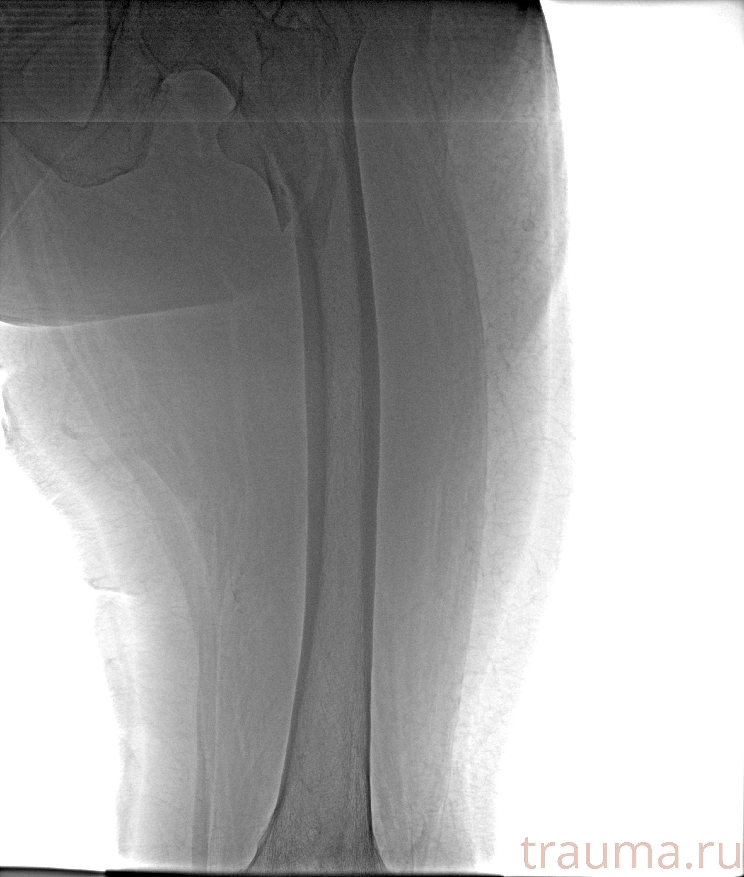 Рентген на дому: по вашему адресу приезжает врач-рентгенолог, травматолог-ортопед с мобильным рентгеновским аппаратом, проводит диагностику травмы или заболевания, делает необходимые рентгенограммы, дает рекомендации по дальнейшему лечению. Получить качественные снимки в домашних условиях возможно благодаря уникальной методике, разработанной МосРентген Центром для института  Склифосовского